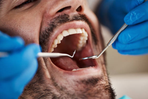 Best Urgent Care for Lost Fillings or Crowns in USA